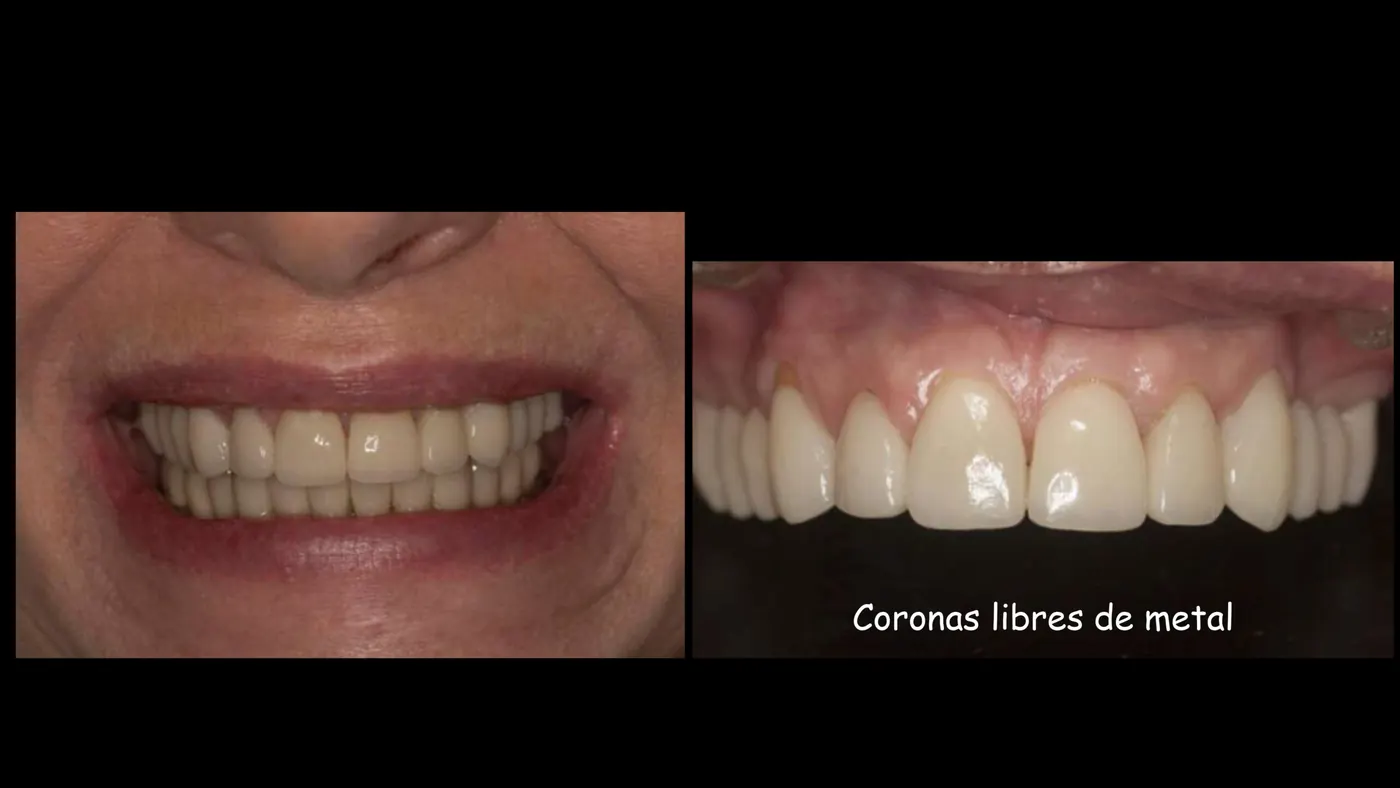 Coronas libres de metal sobre implantes