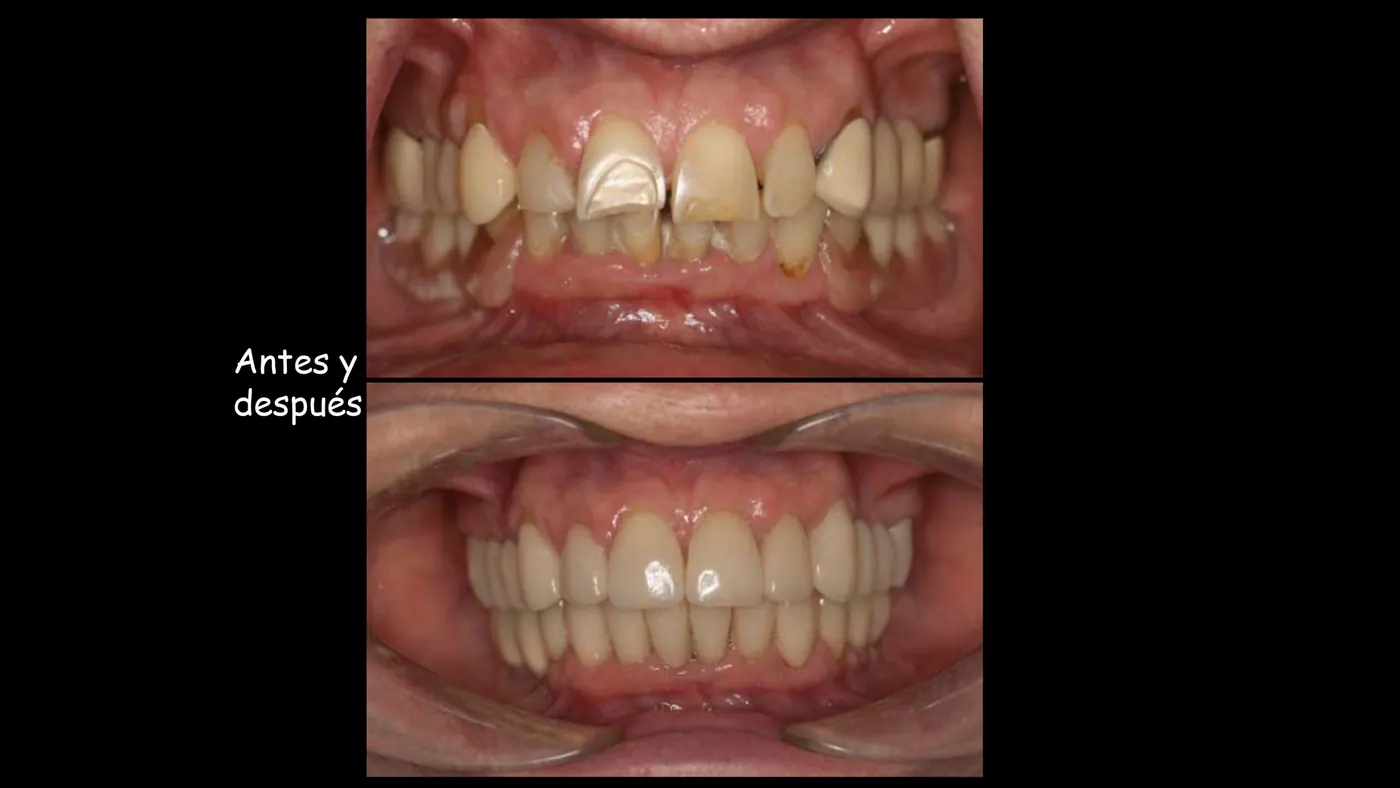Rehabilitación sobre implantes, antes y después