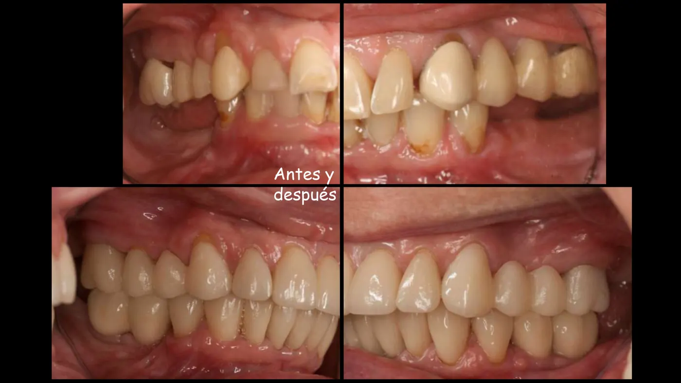 Rehabilitación oclusal, antes y después