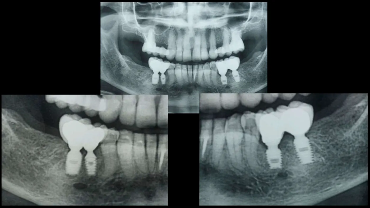 Radiografías panorámicas de rehabilitación oclusal
