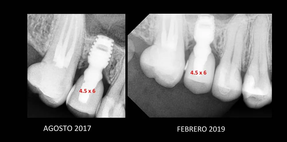 Seguimiento radiográfico de implante Bicon, caso 8