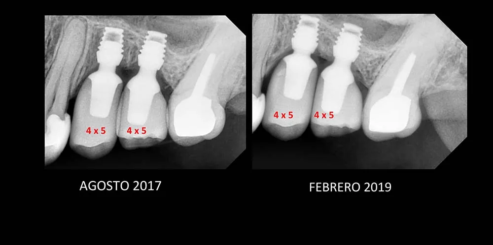 Seguimiento radiográfico de implante Bicon, caso 9