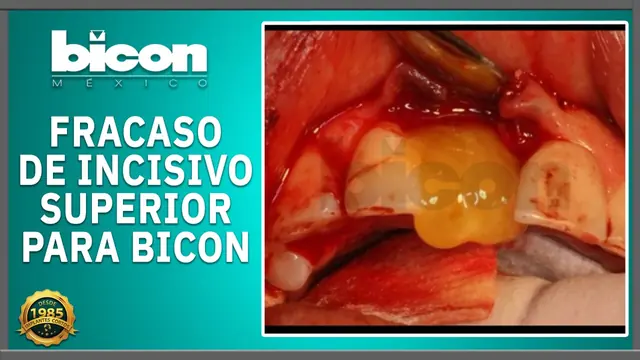 Fracaso de incisivo superior para Bicon