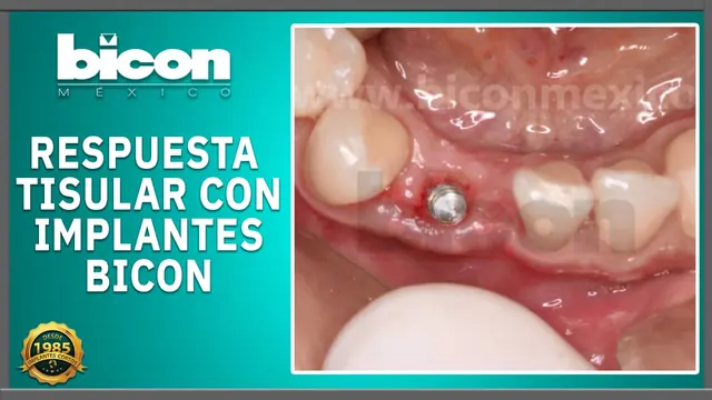 Respuesta tisular con implantes Bicon