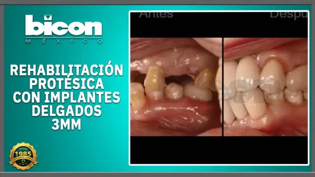 Rehabilitación protésica con implantes delgados de 3 mm